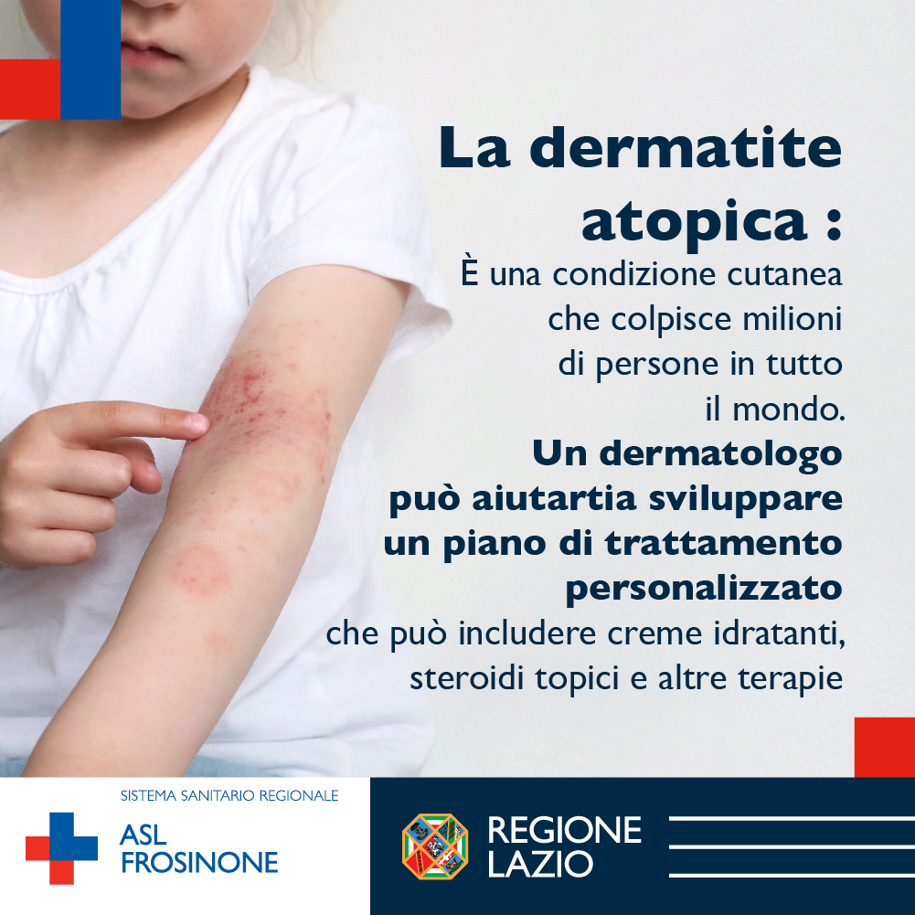 Dermatite Atopica Una Condizione Cutanea Che Colpisce Milioni Di Persone I Consigli Della Asl